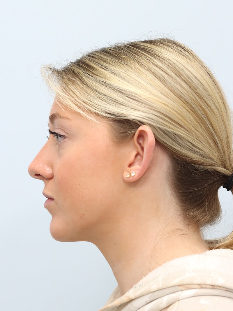 Otoplasty Before & After Gallery - Patient 629771 - Image 9