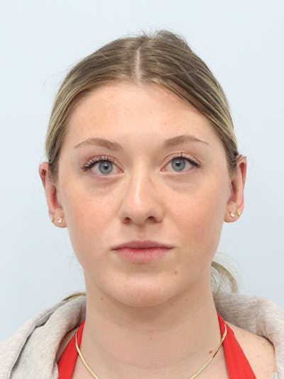 Otoplasty Before & After Gallery - Patient 629771 - Image 2