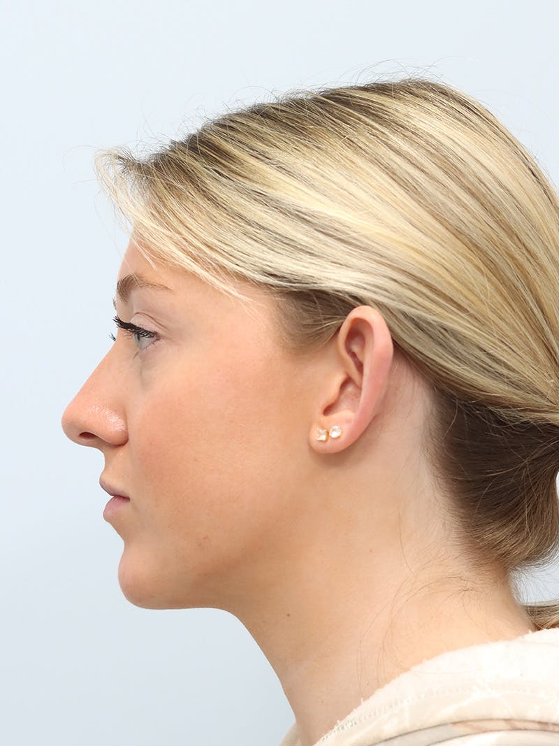 Otoplasty Before & After Gallery - Patient 629771 - Image 5