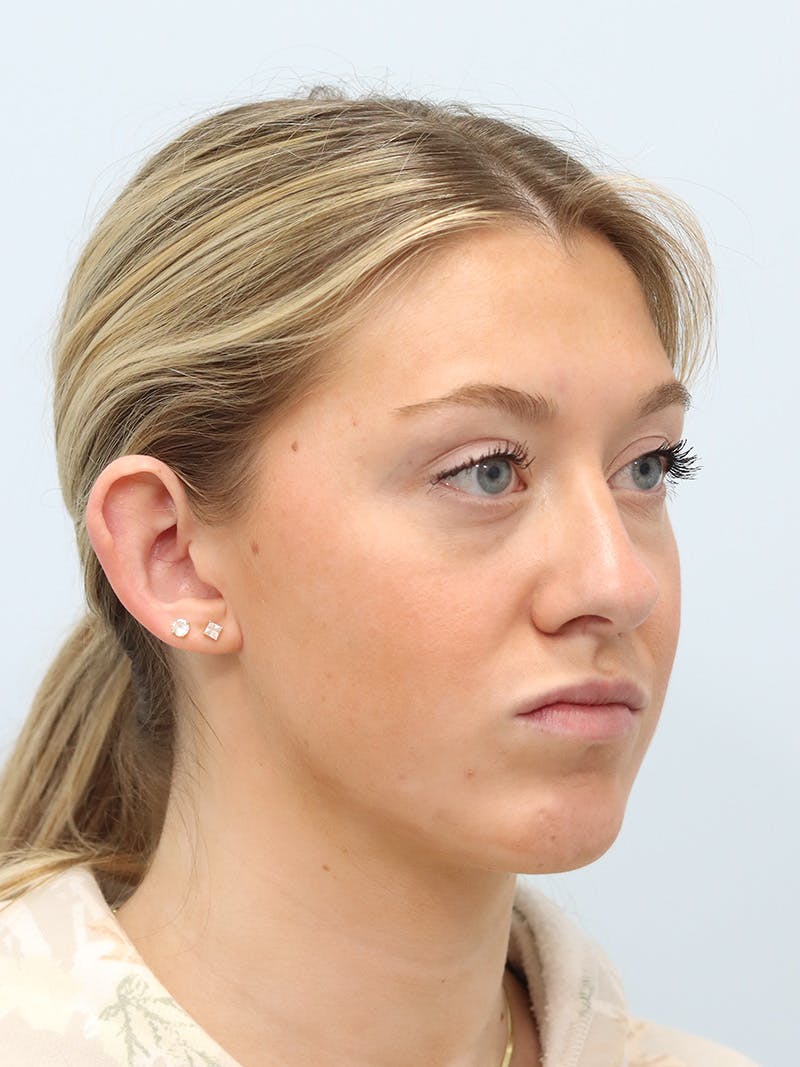Otoplasty Before & After Gallery - Patient 629771 - Image 7