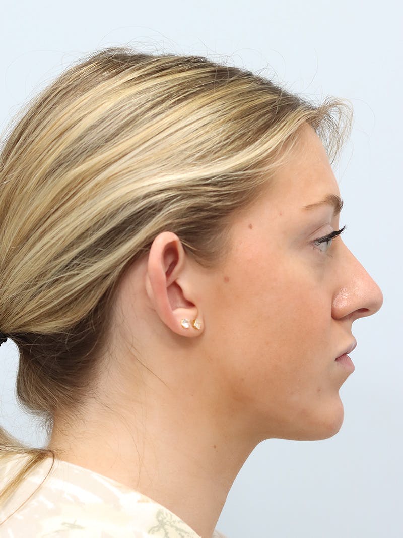 Otoplasty Before & After Gallery - Patient 629771 - Image 9