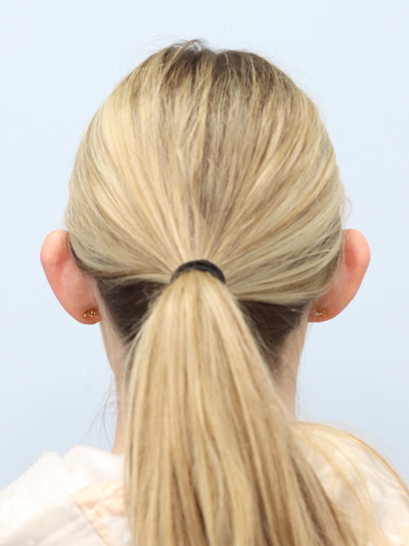 Otoplasty Before & After Gallery - Patient 629771 - Image 11