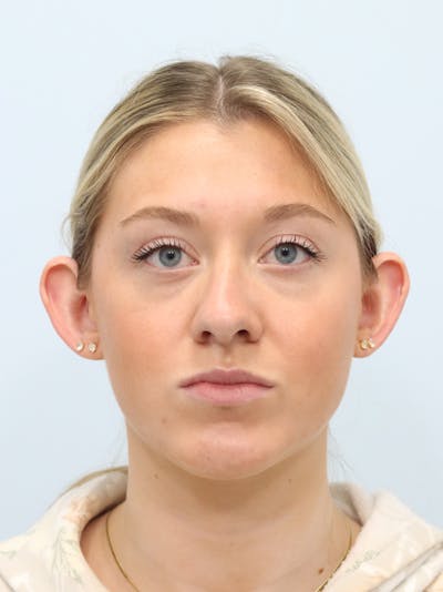 Otoplasty Before & After Gallery - Patient 629771 - Image 1