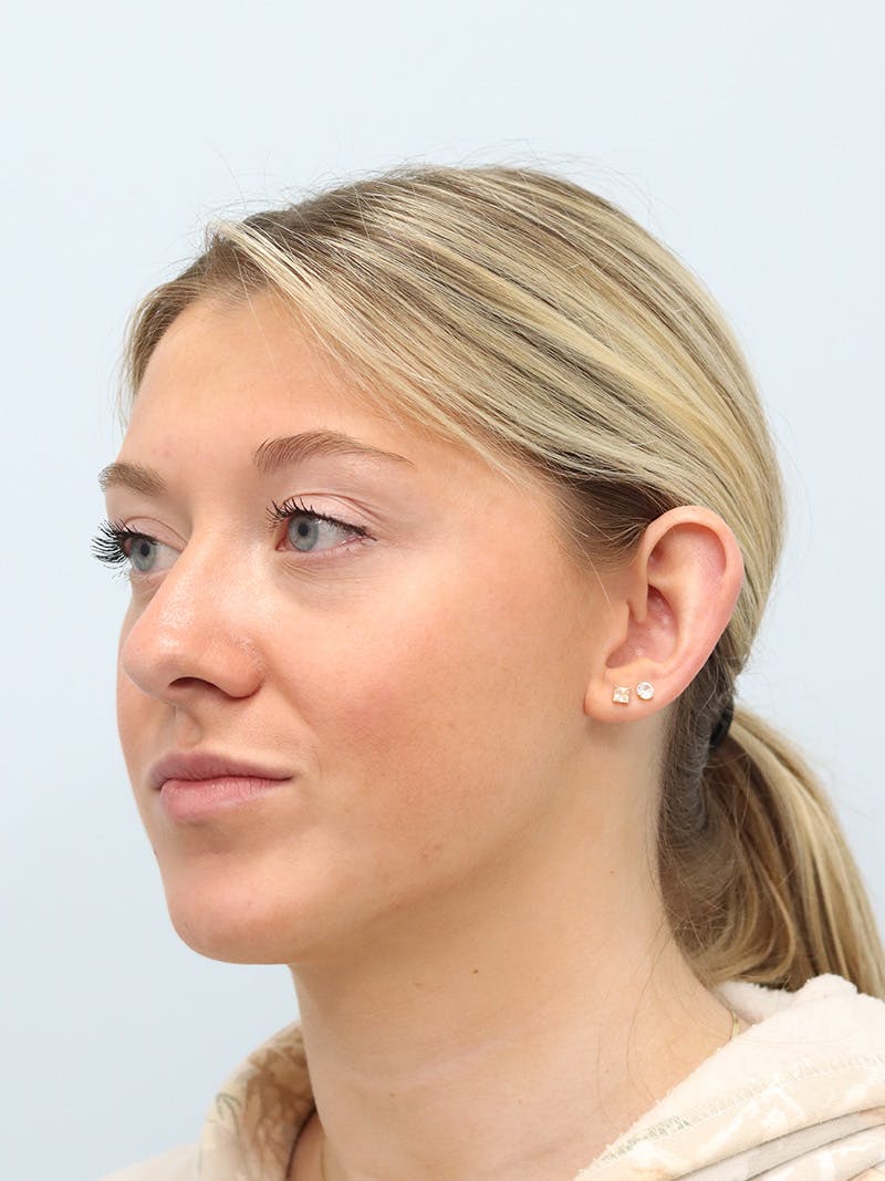 Otoplasty Before & After Gallery - Patient 629771 - Image 3
