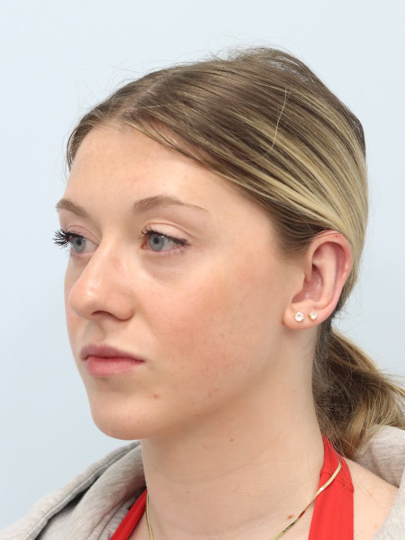 Otoplasty Before & After Gallery - Patient 629771 - Image 4