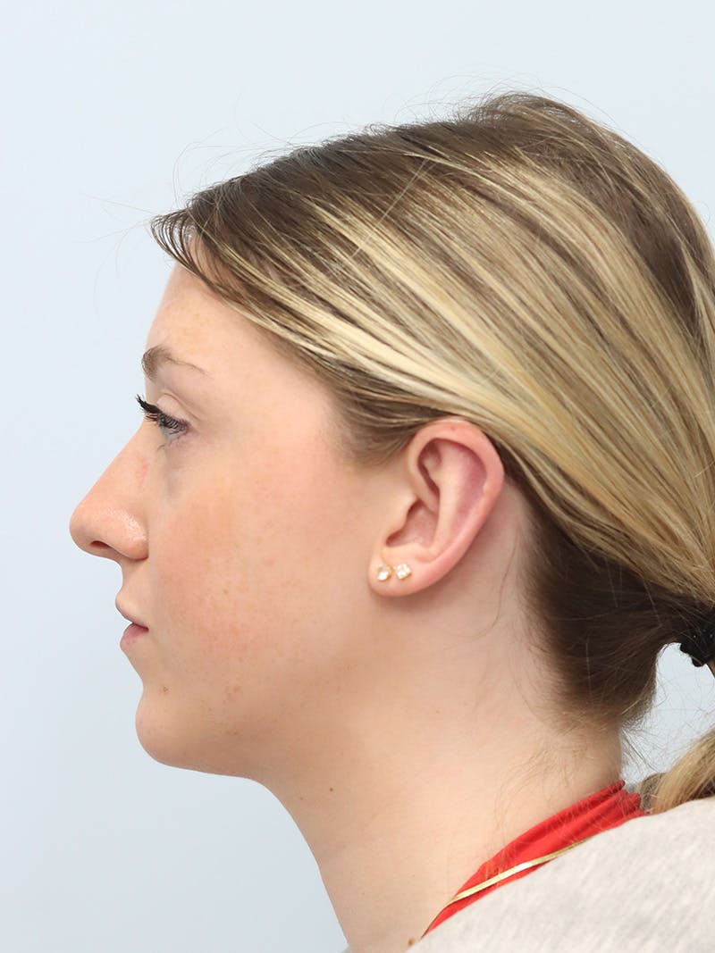 Otoplasty Before & After Gallery - Patient 629771 - Image 6