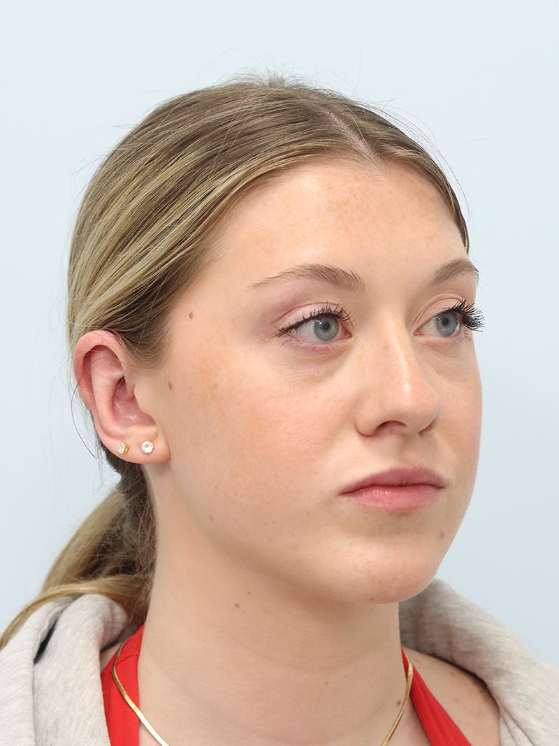 Otoplasty Before & After Gallery - Patient 629771 - Image 8