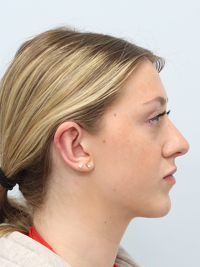 Otoplasty Before & After Gallery - Patient 629771 - Image 10