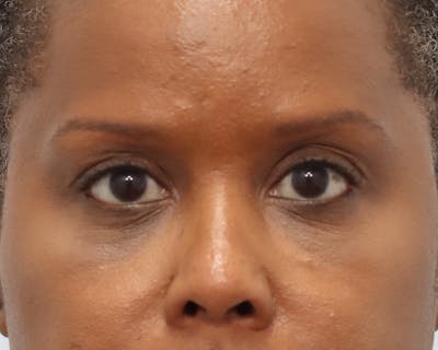 Blepharoplasty Before & After Gallery - Patient 361412 - Image 2