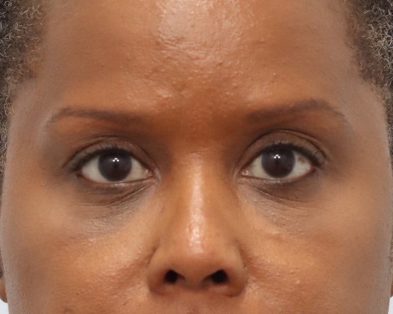Blepharoplasty Before & After Gallery - Patient 361412 - Image 2