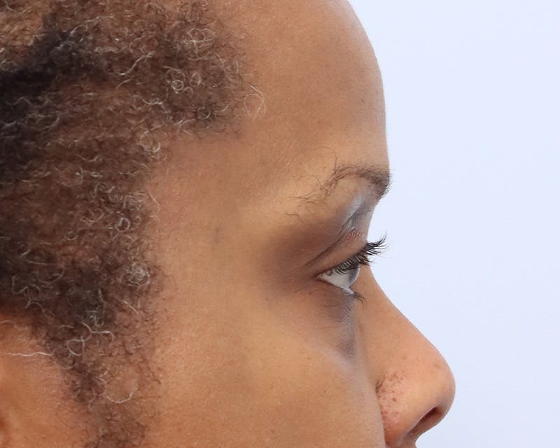 Blepharoplasty Before & After Gallery - Patient 361412 - Image 5