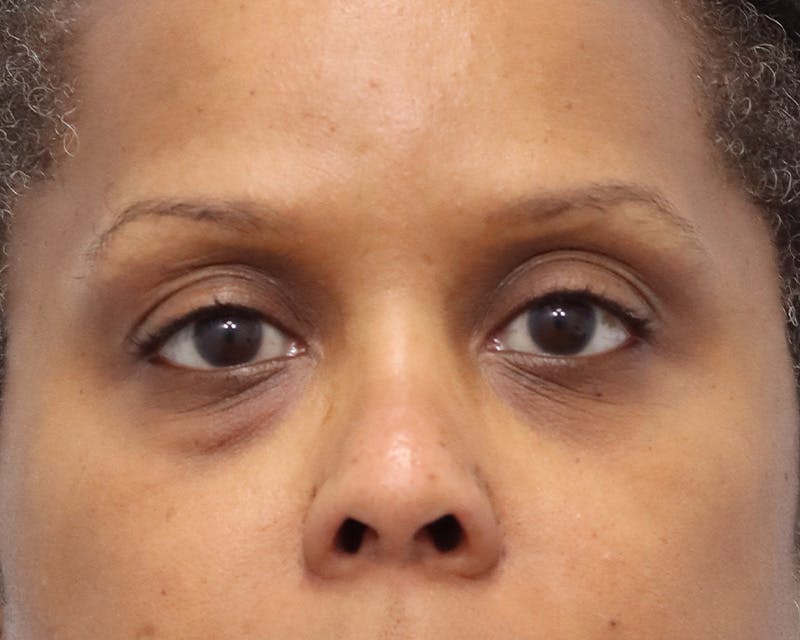 Blepharoplasty Before & After Gallery - Patient 361412 - Image 1