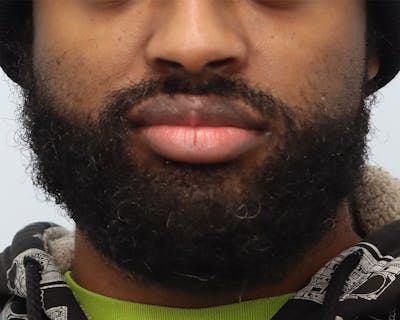 Lip Reduction  Before & After Gallery - Patient 405248 - Image 1
