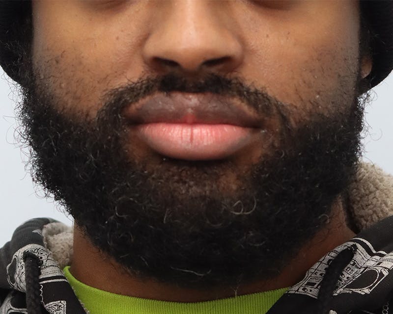 Lip Reduction  Before & After Gallery - Patient 405248 - Image 1