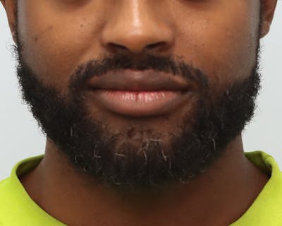 Lip Reduction  Before & After Gallery - Patient 405248 - Image 2