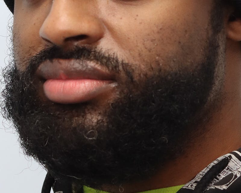 Lip Reduction  Before & After Gallery - Patient 405248 - Image 7
