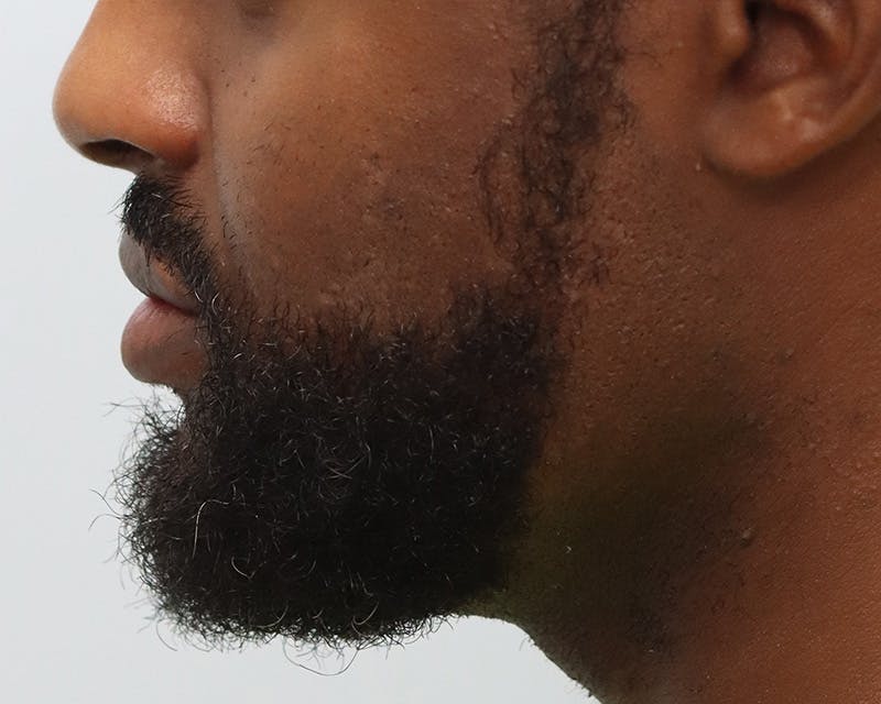 Lip Reduction  Before & After Gallery - Patient 405248 - Image 10