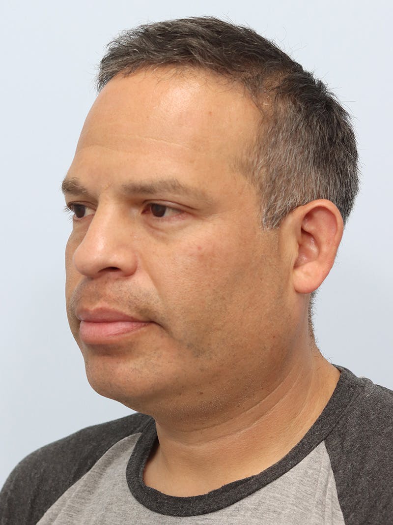 Lip Reduction  Before & After Gallery - Patient 229980 - Image 7