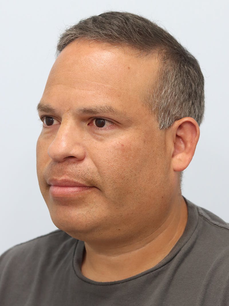 Lip Reduction  Before & After Gallery - Patient 229980 - Image 8