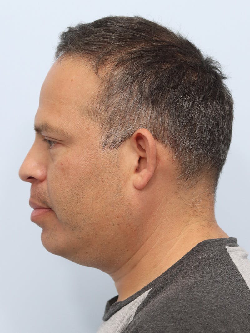 Lip Reduction  Before & After Gallery - Patient 229980 - Image 9