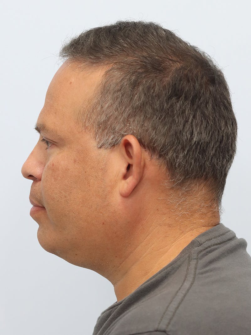 Lip Reduction  Before & After Gallery - Patient 229980 - Image 10