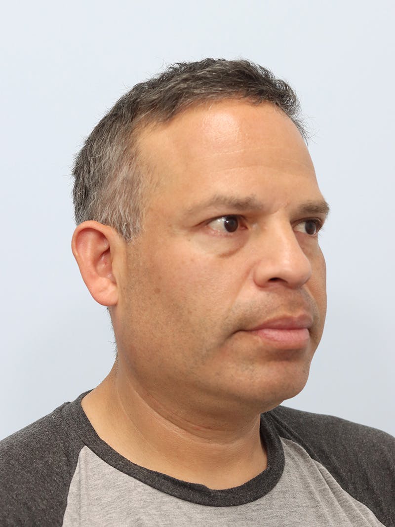 Lip Reduction  Before & After Gallery - Patient 229980 - Image 3