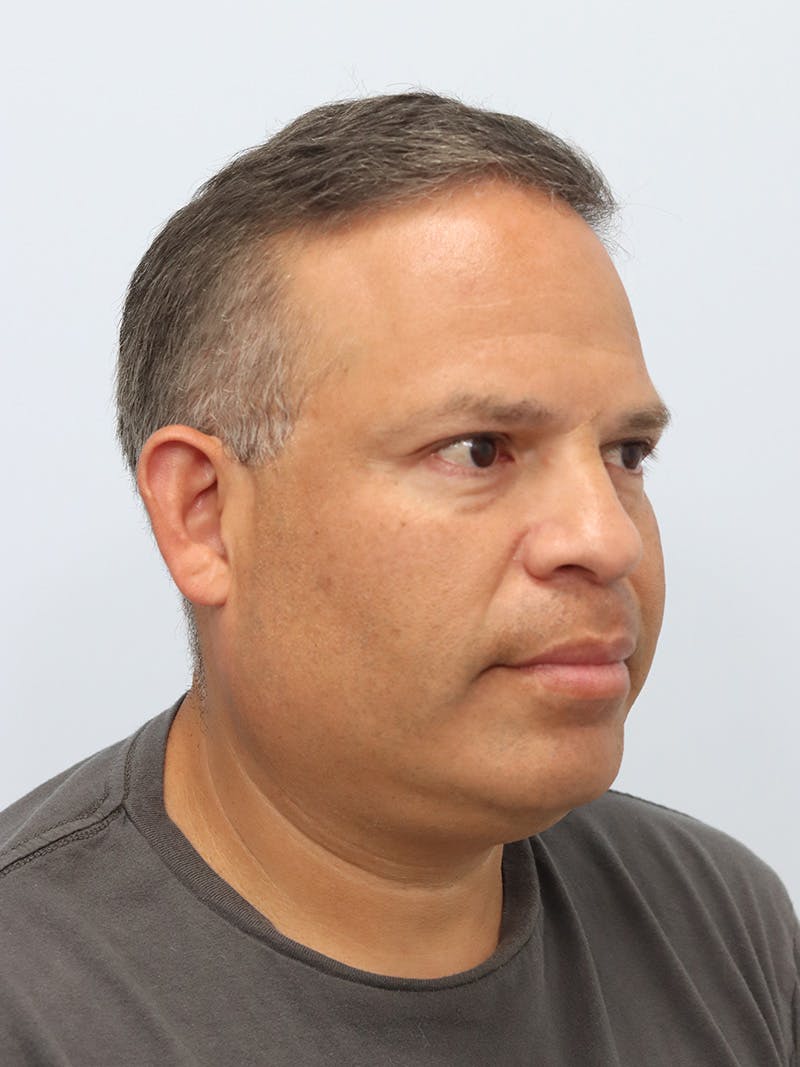 Lip Reduction  Before & After Gallery - Patient 229980 - Image 4