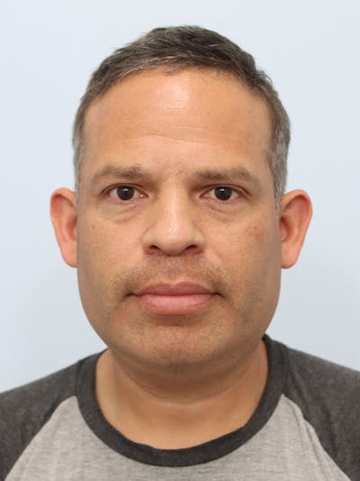 Lip Reduction  Before & After Gallery - Patient 229980 - Image 1