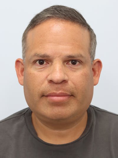 Lip Reduction  Before & After Gallery - Patient 229980 - Image 2