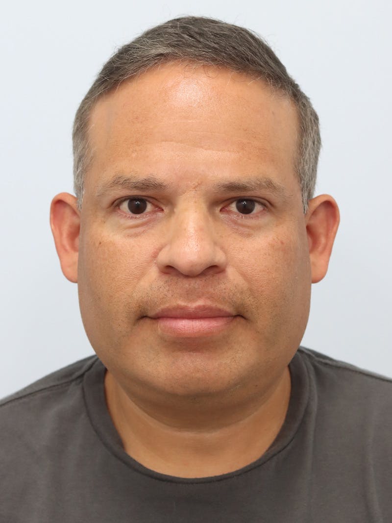 Lip Reduction  Before & After Gallery - Patient 229980 - Image 2