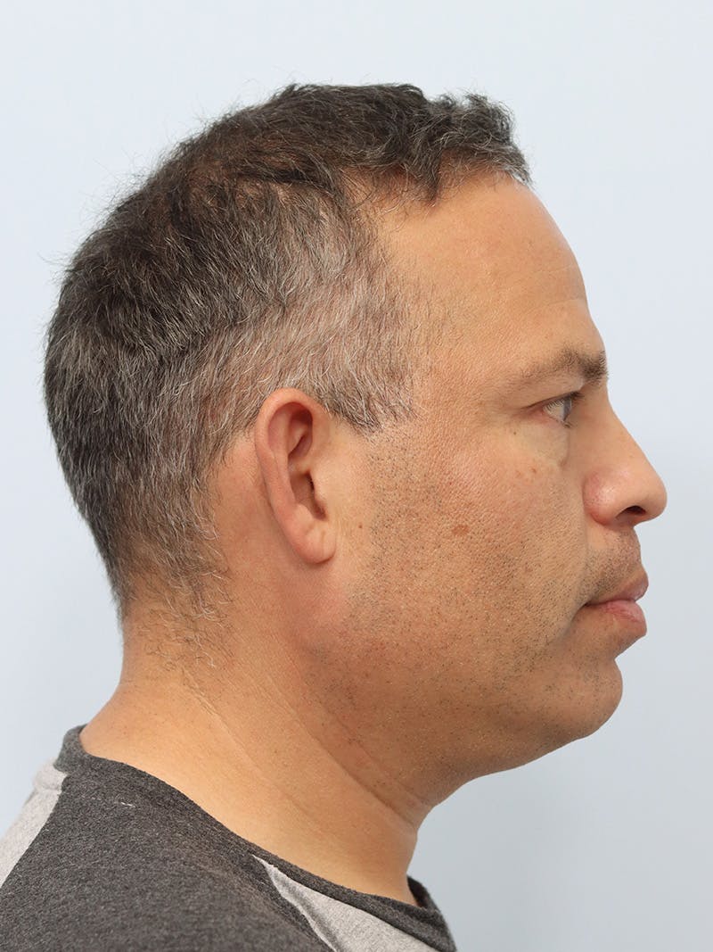 Lip Reduction  Before & After Gallery - Patient 229980 - Image 5