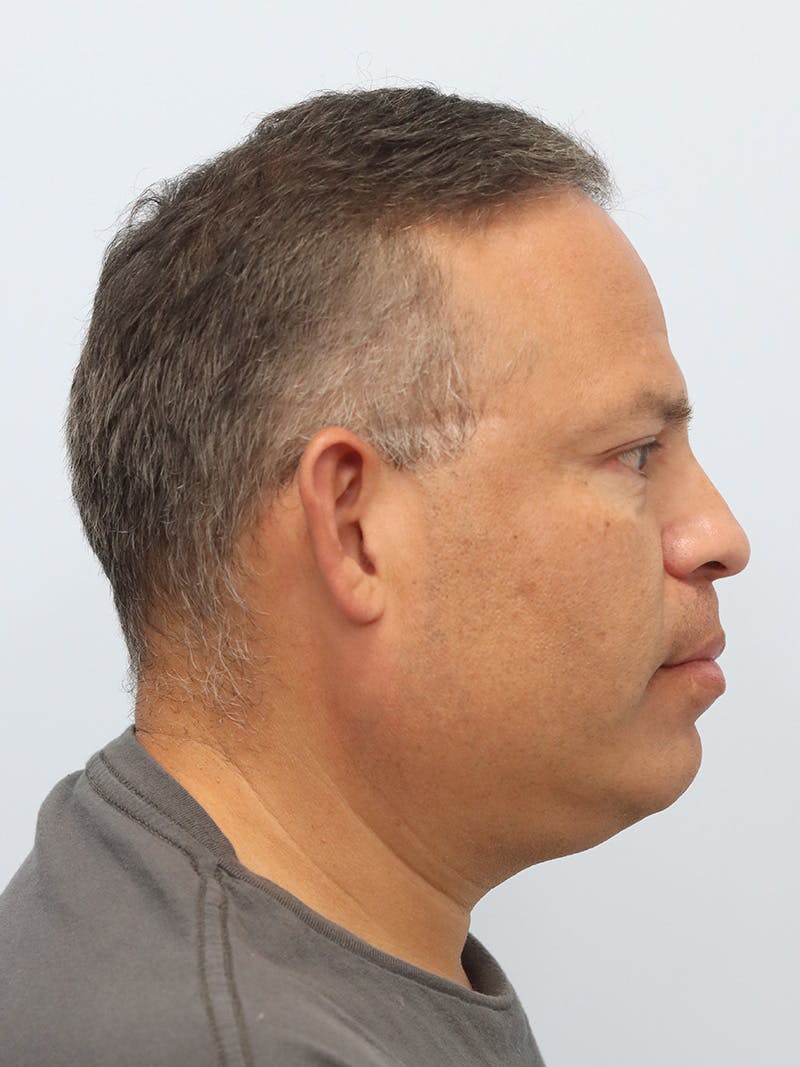Lip Reduction  Before & After Gallery - Patient 229980 - Image 6