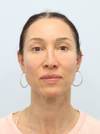 PDO Thread Lift Before & After Gallery - Patient 210991 - Image 2