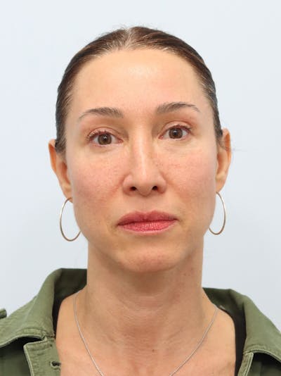 Radiofrequency Skin Tightening Before & After Gallery - Patient 424967 - Image 1