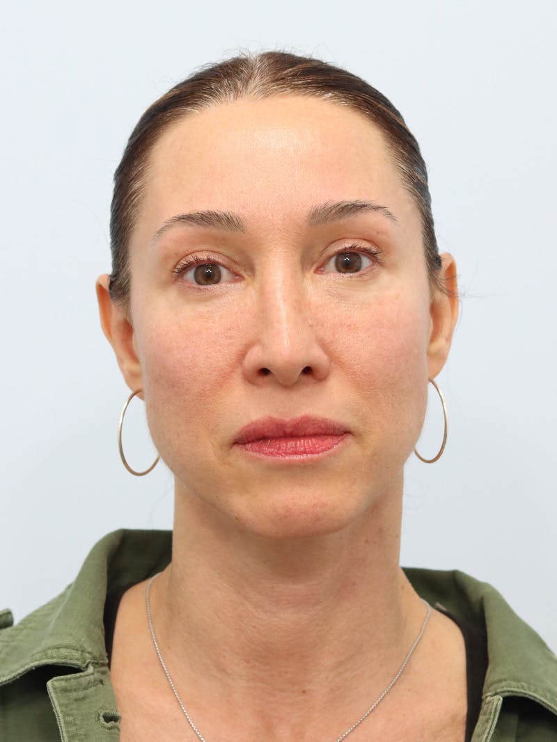 PDO Thread Lift Before & After Gallery - Patient 210991 - Image 1