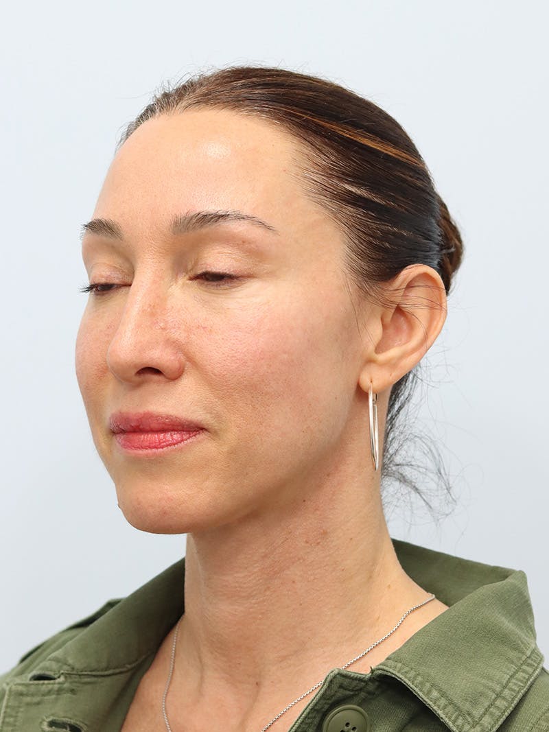 PDO Thread Lift Before & After Gallery - Patient 210991 - Image 7