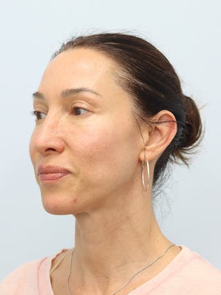 PDO Thread Lift Before & After Gallery - Patient 210991 - Image 8