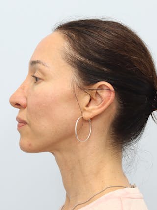 PDO Thread Lift Before & After Gallery - Patient 210991 - Image 10