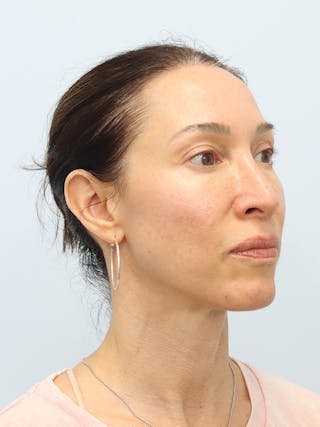 PDO Thread Lift Before & After Gallery - Patient 210991 - Image 4