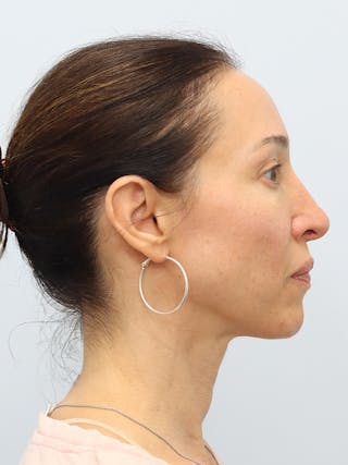 PDO Thread Lift Before & After Gallery - Patient 210991 - Image 6