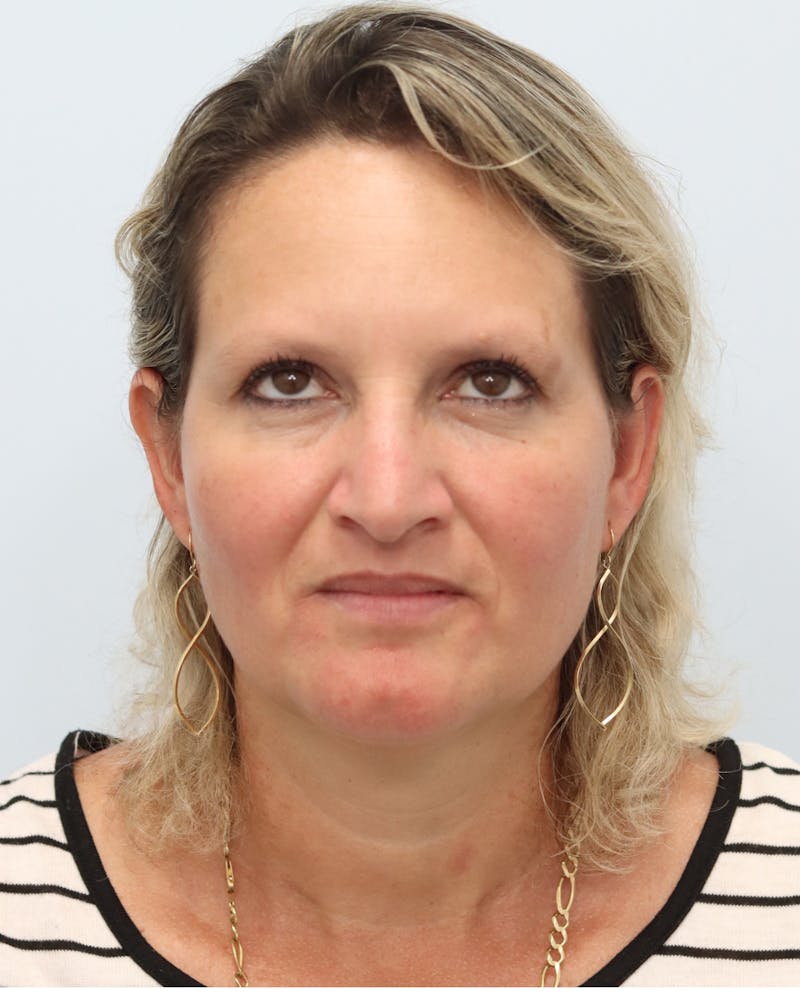 Botox® & Neurotoxins Before & After Gallery - Patient 323264 - Image 6
