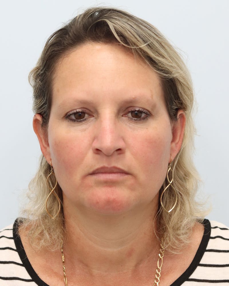 Botox® & Neurotoxins Before & After Gallery - Patient 323264 - Image 4