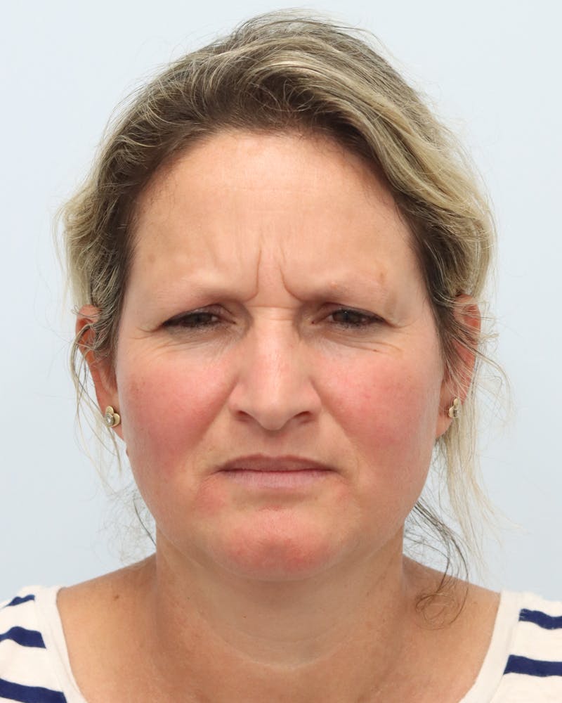 Botox® & Neurotoxins Before & After Gallery - Patient 323264 - Image 7