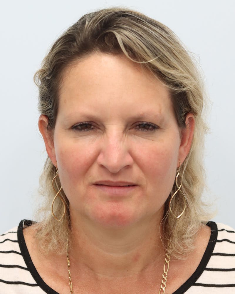 Botox® & Neurotoxins Before & After Gallery - Patient 323264 - Image 8