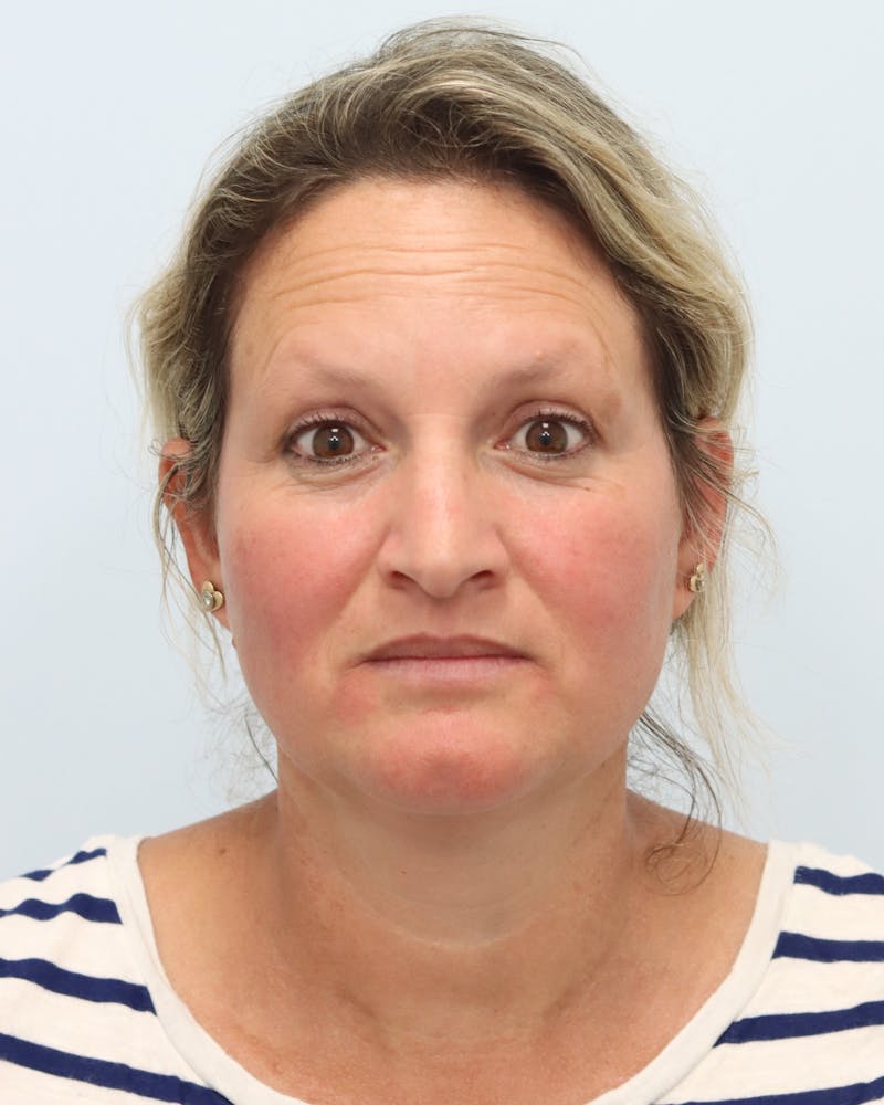 Botox® & Neurotoxins Before & After Gallery - Patient 323264 - Image 5