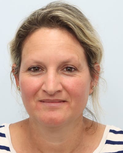 Botox® & Neurotoxins Before & After Gallery - Patient 323264 - Image 1