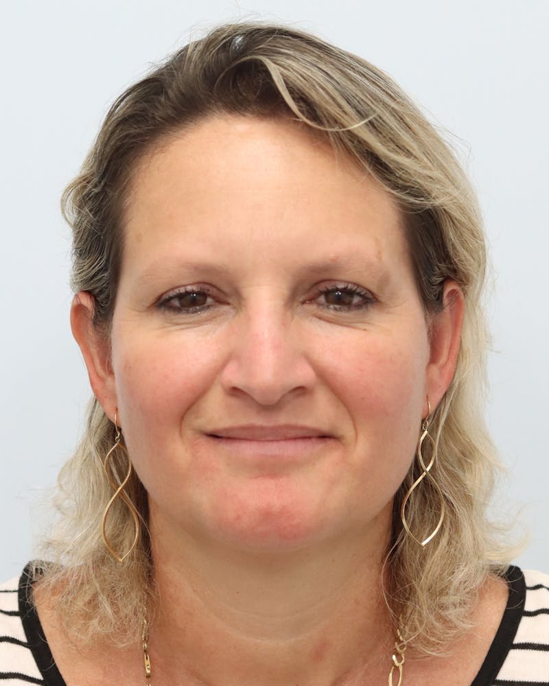 Botox® & Neurotoxins Before & After Gallery - Patient 323264 - Image 2