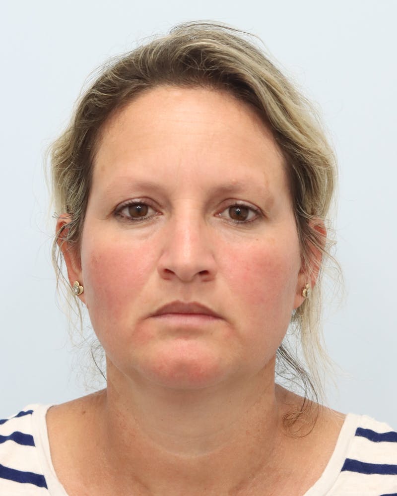 Botox® & Neurotoxins Before & After Gallery - Patient 323264 - Image 3
