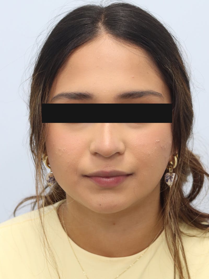 Non-Surgical Rhinoplasty Before & After Gallery - Patient 230553 - Image 4