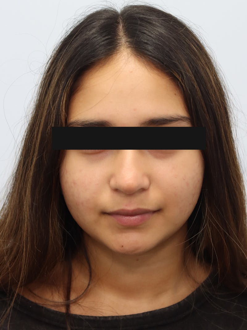Non-Surgical Rhinoplasty Before & After Gallery - Patient 230553 - Image 3